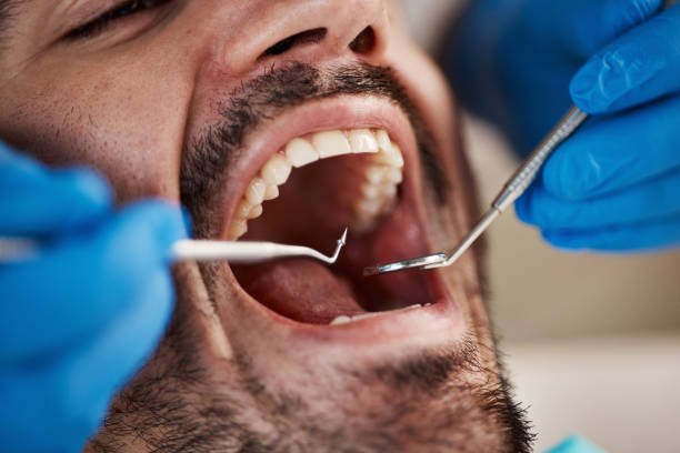 Best Emergency Dentist for Knocked-Out Tooth in Alanes Ridge, CA